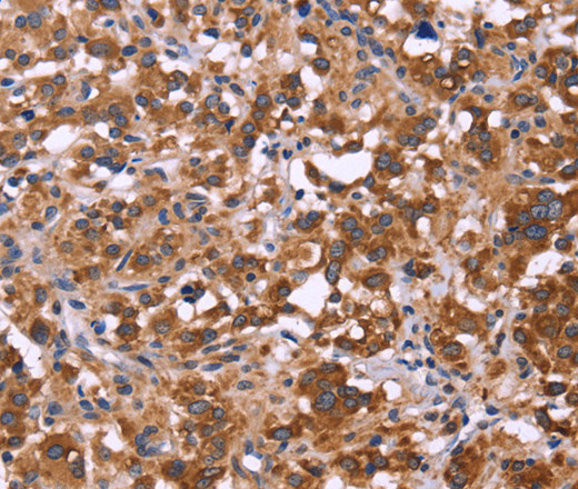 Immunohistochemistry of paraffin-embedded Human thyroid cancer tissue using FBXW7 Polyclonal Antibody at dilution 1:40