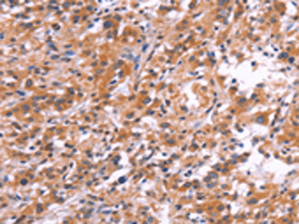 Immunohistochemistry of paraffin-embedded Human thyroid cancer tissue  using APMAP Polyclonal Antibody at dilution of 1:30(?200)