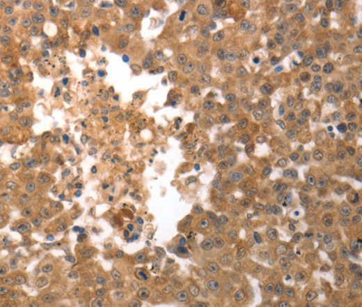 Immunohistochemistry of paraffin-embedded Human breast cancer using SLC22A6 Polyclonal Antibody at dilution of 1:50