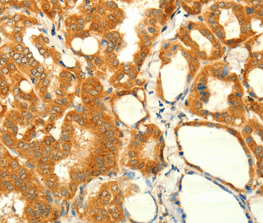 Immunohistochemistry of paraffin-embedded Human thyroid cancer using NAPA Polyclonal Antibody at dilution of 1:35