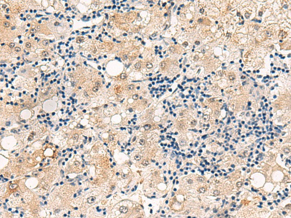 Immunohistochemistry of paraffin-embedded Human liver cancer tissue  using DUSP7 Polyclonal Antibody at dilution of 1:50(?200)