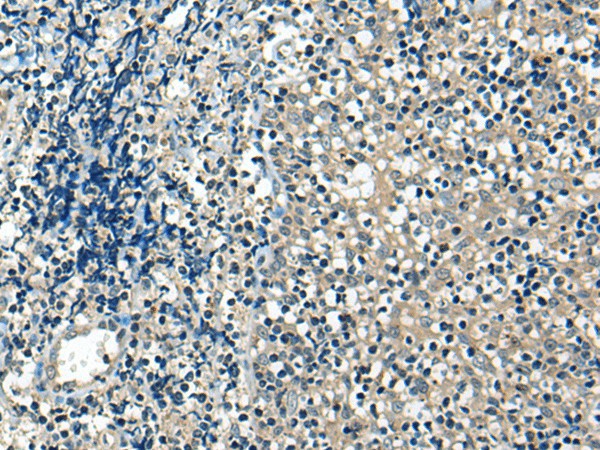 Immunohistochemistry of paraffin-embedded Human tonsil tissue  using USP12 Polyclonal Antibody at dilution of 1:35(?200)