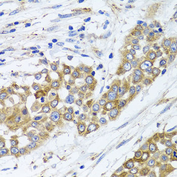 Immunohistochemistry of paraffin-embedded human colon carcinoma using PEX14 Polyclonal antibody at dilution of 1:100 (40x lens).Perform microwave antigen retrieval with 10 mM PBS buffer pH 7.2 before commencing with IHC staining protocol.