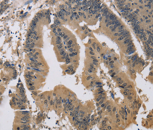 Immunohistochemistry of paraffin-embedded Human colon cancer tissue using JAG1 Polyclonal Antibody at dilution 1:40