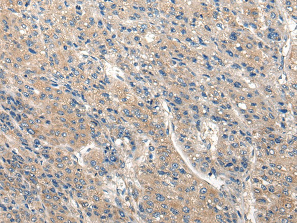 Immunohistochemistry of paraffin-embedded Human liver cancer tissue  using CLIC6 Polyclonal Antibody at dilution of 1:40(?200)