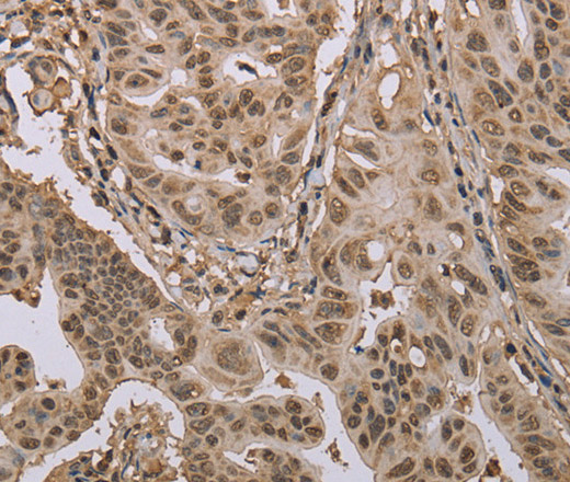 Immunohistochemistry of paraffin-embedded Human gastric cancer using CAB39 Polyclonal Antibody at dilution of 1:50