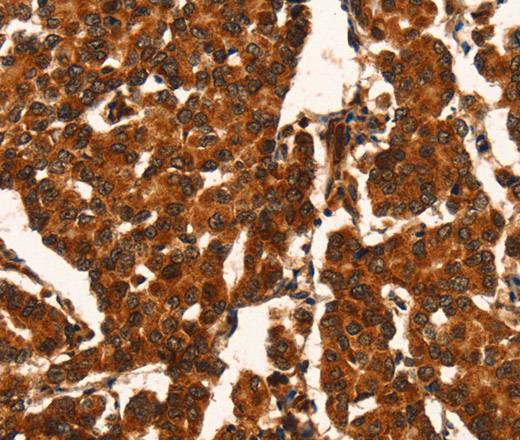 Immunohistochemistry of paraffin-embedded Human breast cancer using CUEDC2 Polyclonal Antibody at dilution of 1:50