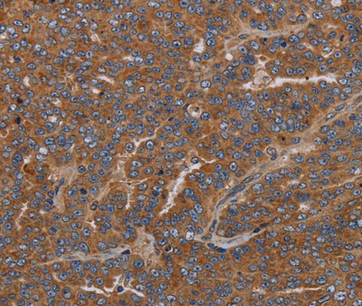 Immunohistochemistry of paraffin-embedded Human ovarian cancer using GDF2 Polyclonal Antibody at dilution of 1:40