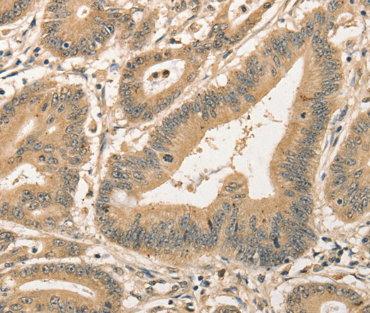 Immunohistochemistry of paraffin-embedded Human colon cancer using CDCA8 Polyclonal Antibody at dilution of 1:40