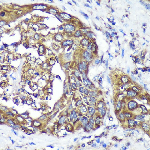 Immunohistochemistry of paraffin-embedded Human lung cancer using ANKLE2 Polyclonal Antibody at dilution of 1:100 (40x lens).Perform microwave antigen retrieval with 10 mM PBS buffer pH 7.2 before commencing with IHC staining protocol.