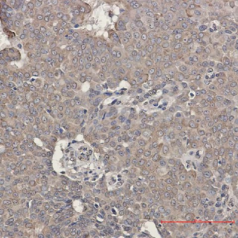 Immunohistochemistry of GRP78 BiP in paraffin-embedded Human breast cancer tissue using GRP78 BiP Rabbit mAb at dilution 1:50