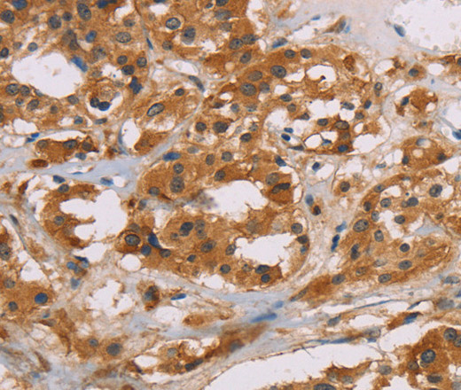 Immunohistochemistry of paraffin-embedded Human thyroid cancer tissue using CD22 Polyclonal Antibody at dilution 1:50