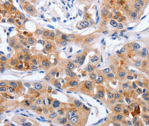 Immunohistochemistry of paraffin-embedded Human lung cancer using NCK1 Polyclonal Antibody at dilution of 1:30