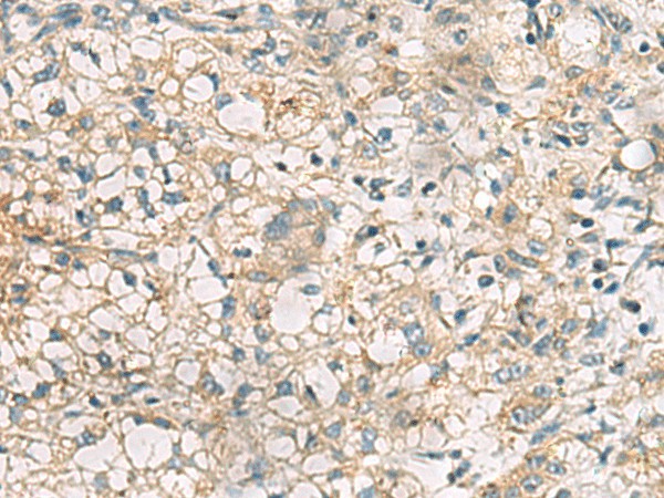 Immunohistochemistry of paraffin-embedded Human liver cancer tissue  using RTP4 Polyclonal Antibody at dilution of 1:50(?200)