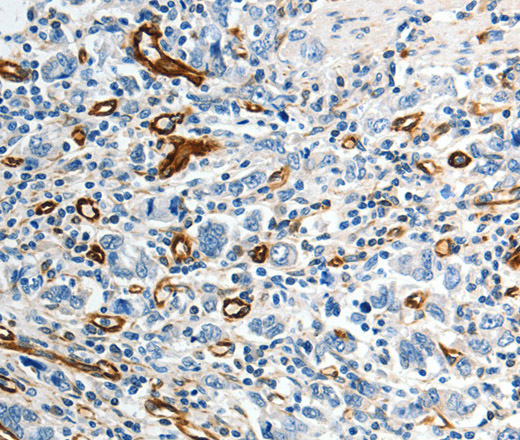 Immunohistochemistry of paraffin-embedded Human gastic cancer using ABCG1 Polyclonal Antibody at dilution of 1:40