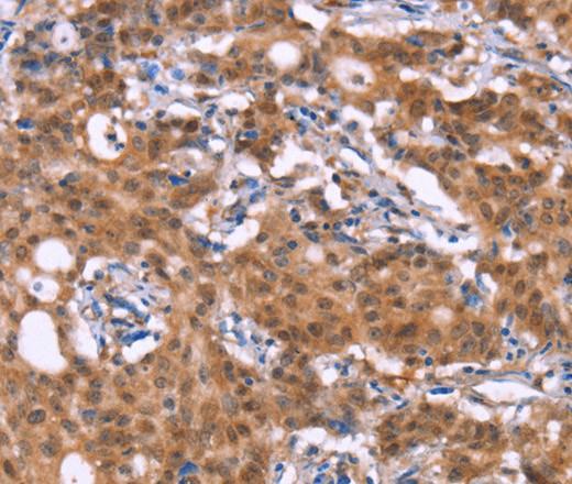 Immunohistochemistry of paraffin-embedded Human gastric cancer tissue using BRK1 Polyclonal Antibody at dilution 1:30