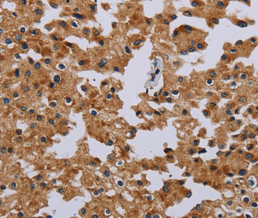 Immunohistochemistry of paraffin-embedded Human prostate cancer tissue using IFRD1 Polyclonal Antibody at dilution 1:40