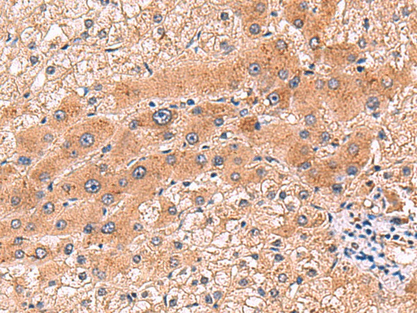 Immunohistochemistry of paraffin-embedded Human liver cancer tissue  using CCL13 Polyclonal Antibody at dilution of 1:90(?200)