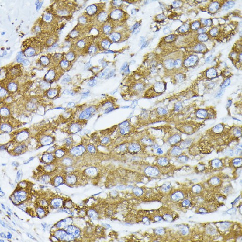 Immunohistochemistry of paraffin-embedded human liver cancer using BiP/GRP78 Polyclonal antibody at dilution of 1:100 (40x lens).Perform microwave antigen retrieval with 10 mM PBS buffer pH 7.2 before commencing with IHC staining protocol.