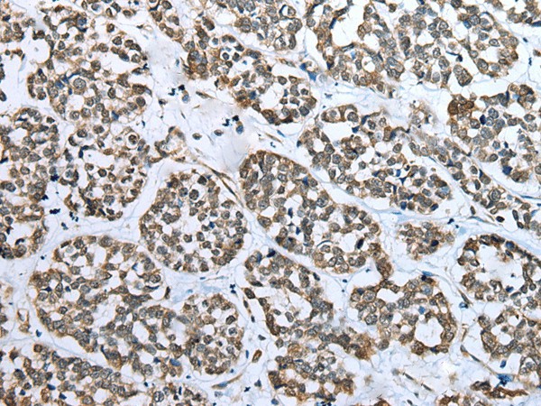 Immunohistochemistry of paraffin-embedded Human esophagus cancer tissue  using CARTPT Polyclonal Antibody at dilution of 1:25(?200)