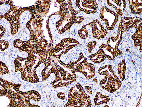 Immunohistochemistry of paraffinembedded Human lung adenocarcinoma with Napsin A Monoclonal Antibody(Antigen repaired by EDTA).