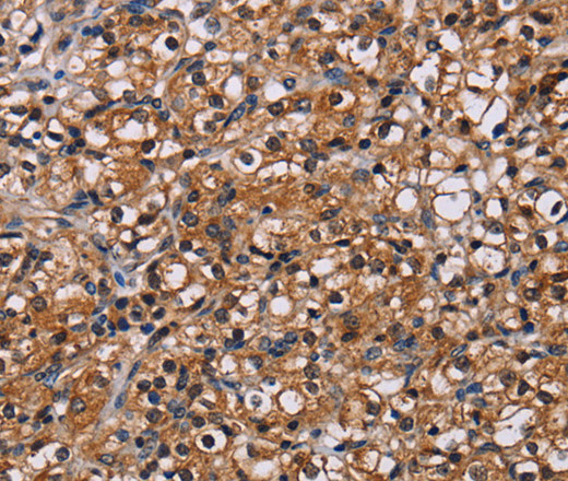 Immunohistochemistry of paraffin-embedded Human prostate cancer using NPM3 Polyclonal Antibody at dilution of 1:60