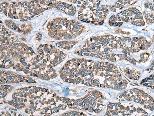 Immunohistochemistry of paraffin-embedded Human esophagus cancer tissue  using CADM2 Polyclonal Antibody at dilution of 1:40(?200)