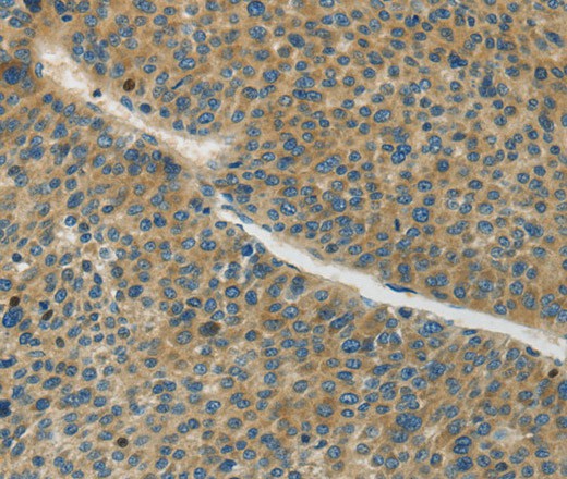 Immunohistochemistry of paraffin-embedded Human liver cancer tissue using Connexin-45 Polyclonal Antibody at dilution 1:50