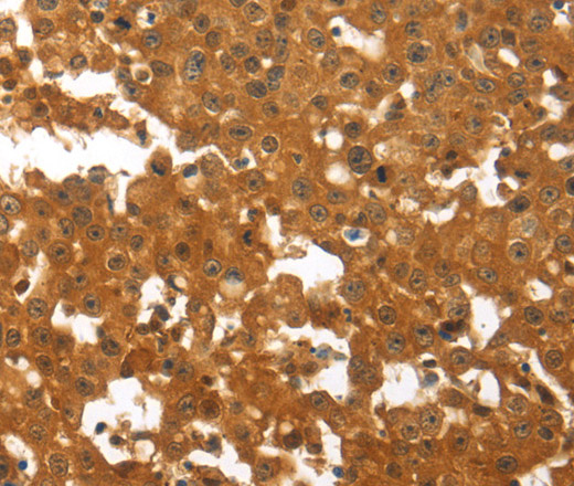 Immunohistochemistry of paraffin-embedded Human breast cancer using TNFRSF11B Polyclonal Antibody at dilution of 1:30