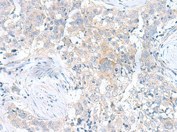 Immunohistochemistry of paraffin-embedded Human esophagus cancer tissue  using UBE2F Polyclonal Antibody at dilution of 1:100(?200)