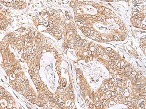 Immunohistochemistry of paraffin-embedded Human gastric cancer tissue  using SEC11A Polyclonal Antibody at dilution of 1:45(?200)