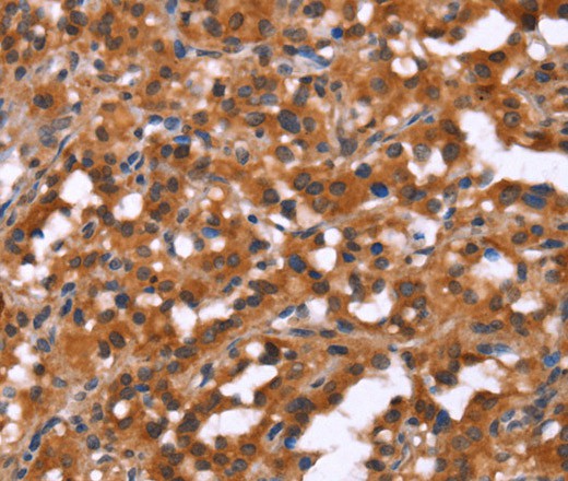 Immunohistochemistry of paraffin-embedded Human thyroid cancer using HINT1 Polyclonal Antibody at dilution of 1:50