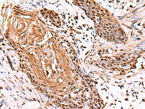 Immunohistochemistry of paraffin-embedded Human esophagus cancer tissue  using ITPR2 Polyclonal Antibody at dilution of 1:65(?200)