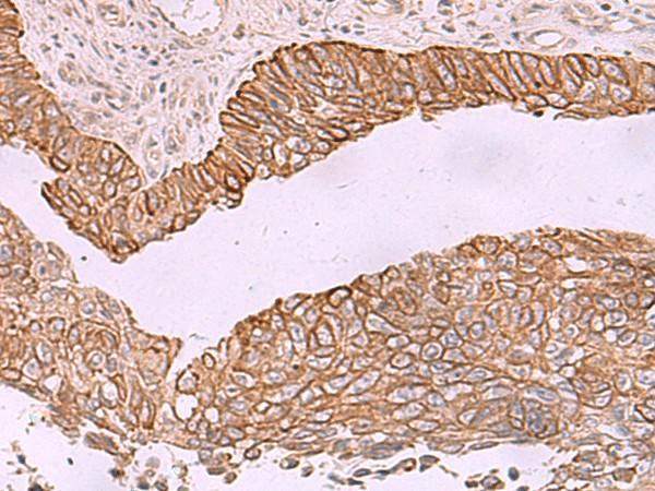 Immunohistochemistry of paraffin-embedded Human lung cancer tissue  using KCNK12 Polyclonal Antibody at dilution of 1:60(?200)