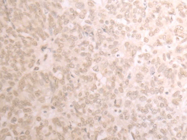 Immunohistochemistry of paraffin-embedded Human ovarian cancer tissue  using TRMT1 Polyclonal Antibody at dilution of 1:25(?200)