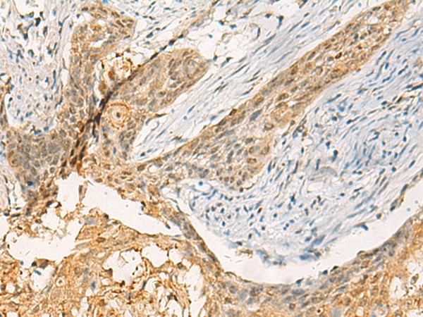 Immunohistochemistry of paraffin-embedded Human esophagus cancer tissue  using TBCK Polyclonal Antibody at dilution of 1:40(?200)