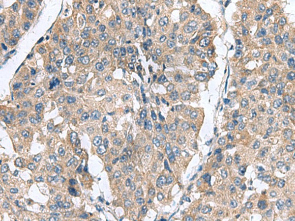 Immunohistochemistry of paraffin-embedded Human liver cancer tissue  using CLEC1B Polyclonal Antibody at dilution of 1:60(?200)