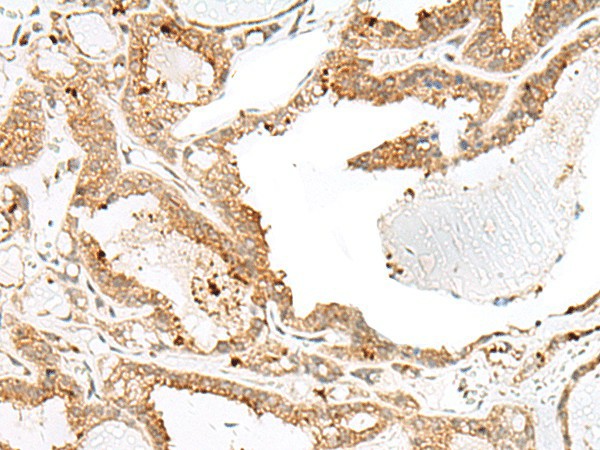 Immunohistochemistry of paraffin-embedded Human thyroid cancer tissue  using ENAH Polyclonal Antibody at dilution of 1:60(?200)