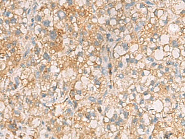 Immunohistochemistry of paraffin-embedded Human liver cancer tissue  using ANXA13 Polyclonal Antibody at dilution of 1:105(?200)