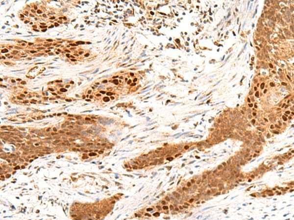 Immunohistochemistry of paraffin-embedded Human esophagus cancer tissue  using MKX Polyclonal Antibody at dilution of 1:50(?200)