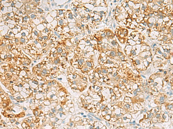 Immunohistochemistry of paraffin-embedded Human liver cancer tissue  using SH3YL1 Polyclonal Antibody at dilution of 1:55(?200)