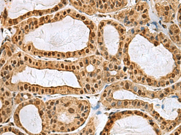 Immunohistochemistry of paraffin-embedded Human thyroid cancer tissue  using MYEF2 Polyclonal Antibody at dilution of 1:55(?200)