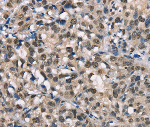 Immunohistochemistry of paraffin-embedded Human esophagus cancer using NSMCE3 Polyclonal Antibody at dilution of 1:40