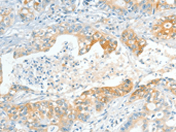 Immunohistochemistry of paraffin-embedded Human gastric cancer tissue  using APOL2 Polyclonal Antibody at dilution of 1:80(?200)