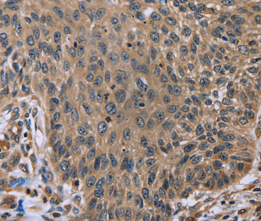 Immunohistochemistry of paraffin-embedded Human lung cancer tissue using EDA Polyclonal Antibody at dilution 1:50