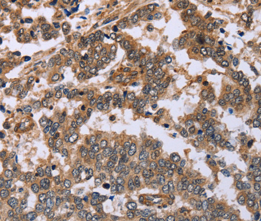 Immunohistochemistry of paraffin-embedded Human liver cancer tissue using FAF1 Polyclonal Antibody at dilution 1:40