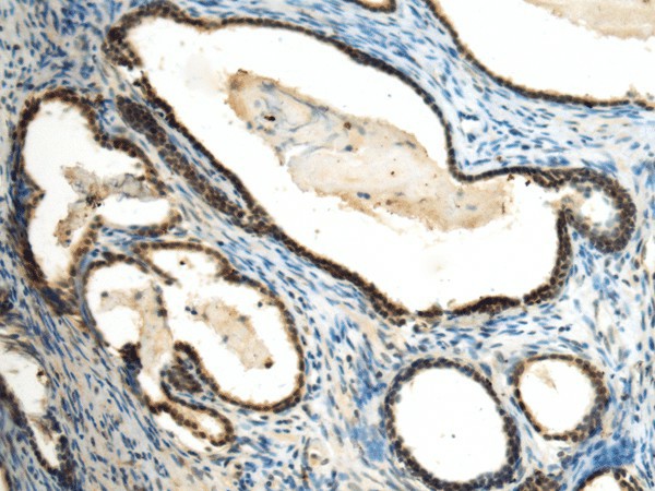 Immunohistochemistry of paraffin-embedded Human prost at e cancer tissue  using SUV39H2 Polyclonal Antibody at dilution of 1:70(?200)