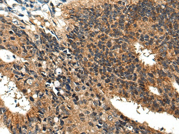 Immunohistochemistry of paraffin-embedded Human colorectal cancer tissue  using BMPER Polyclonal Antibody at dilution of 1:40(?200)