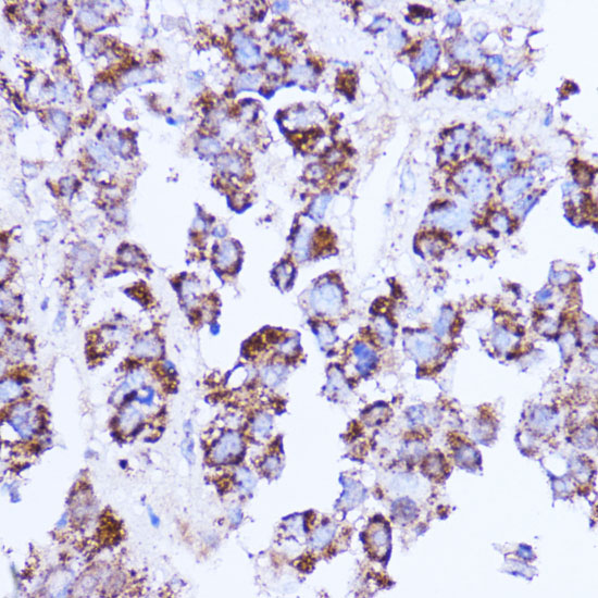 Immunohistochemistry of paraffin-embedded Human liver cancer using SHMT2 Polyclonal Antibody at dilution of 1:100 (40x lens).