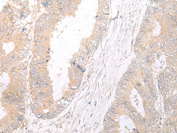 Immunohistochemistry of paraffin-embedded Human colorectal cancer tissue  using HLA-C Polyclonal Antibody at dilution of 1:25(?200)